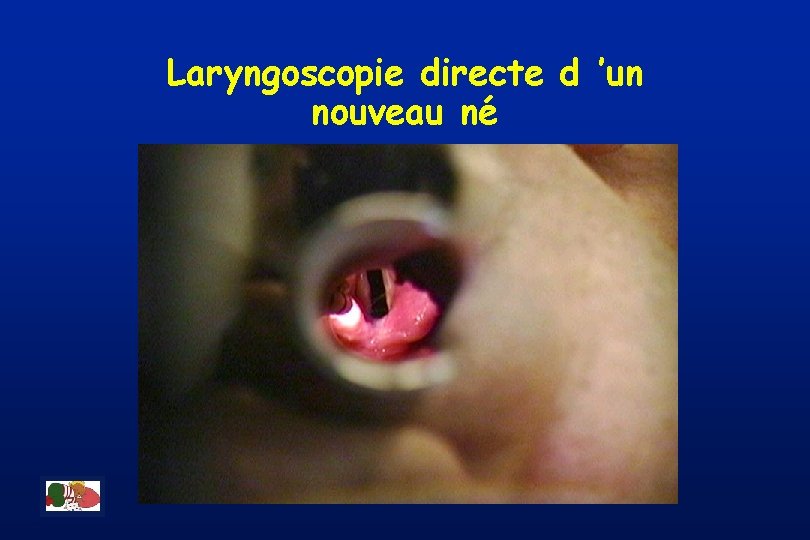 Laryngoscopie directe d ’un nouveau né 