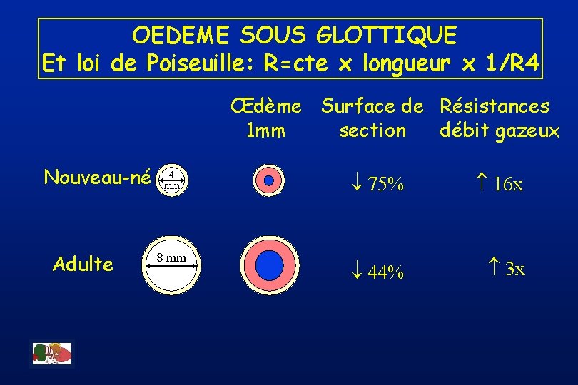 OEDEME SOUS GLOTTIQUE Et loi de Poiseuille: R=cte x longueur x 1/R 4 Œdème