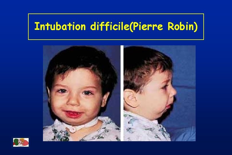 Intubation difficile(Pierre Robin) 