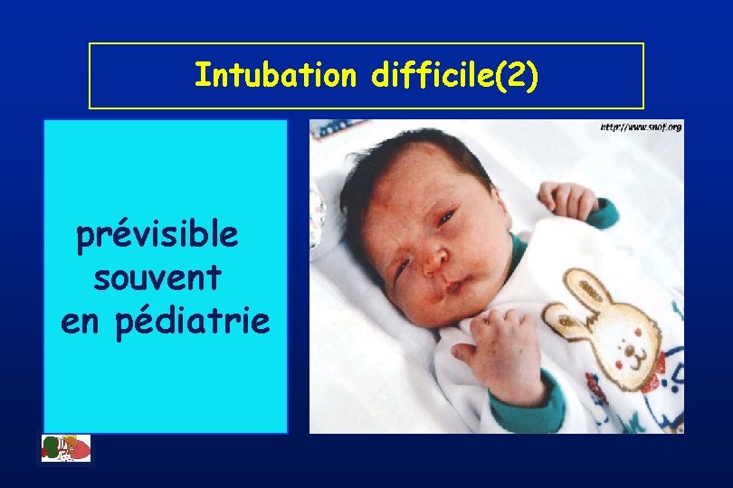 Intubation difficile(2) prévisible souvent en pédiatrie 