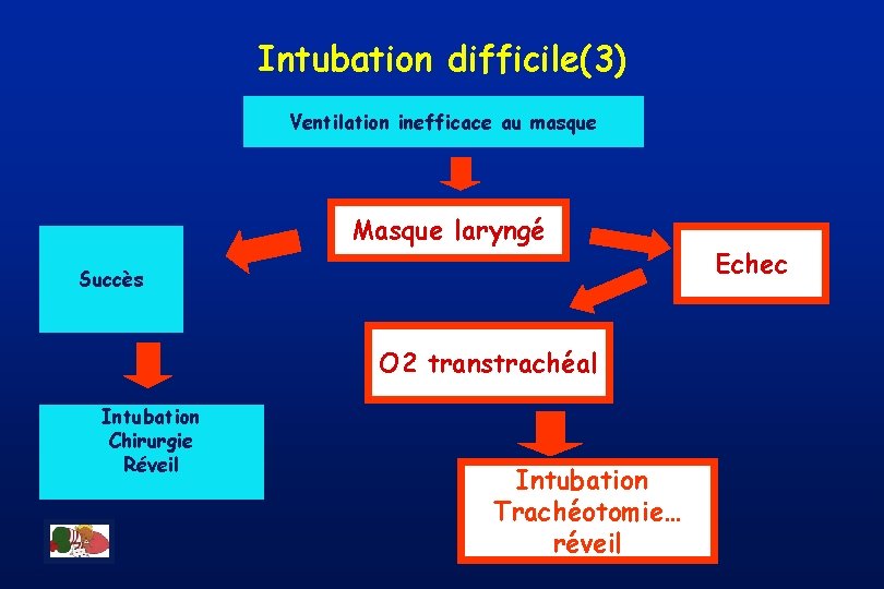 Intubation difficile(3) Ventilation inefficace au masque Masque laryngé Succès O 2 transtrachéal Intubation Chirurgie