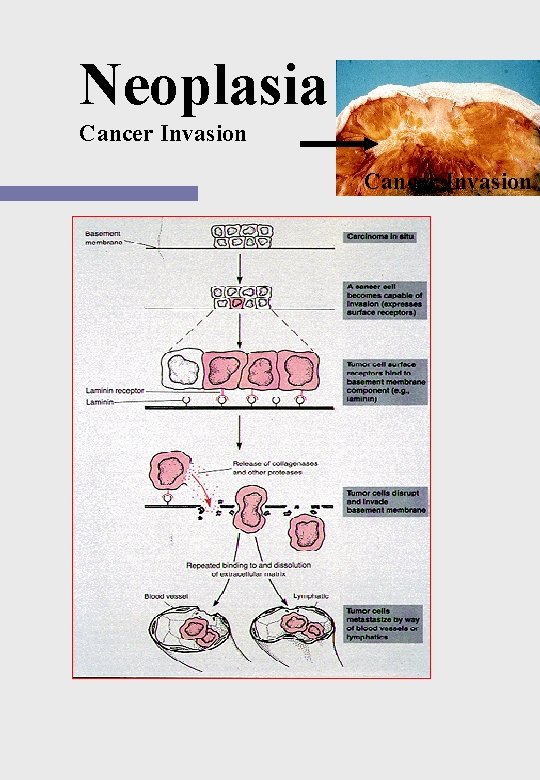 Neoplasia Cancer Invasion 