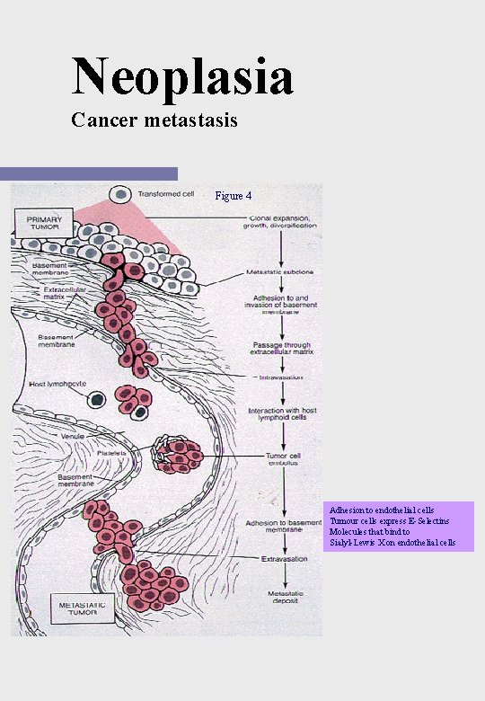 Neoplasia Cancer metastasis Figure 4 Adhesion to endothelial cells Tumour cells express E-Selectins Molecules