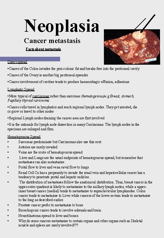 Neoplasia Cancer metastasis Multiple Liver Metastases Facts about metastasis Direct spread • Cancer of