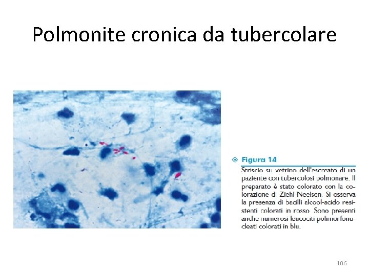 Polmonite cronica da tubercolare 106 