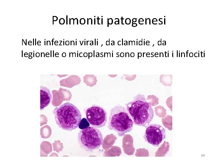 Polmoniti patogenesi Nelle infezioni virali , da clamidie , da legionelle o micoplasmi sono