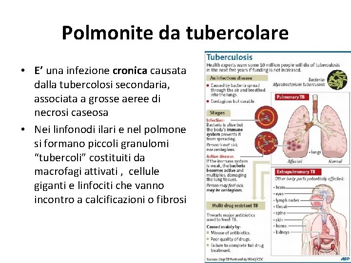 Polmonite da tubercolare • E’ una infezione cronica causata dalla tubercolosi secondaria, associata a