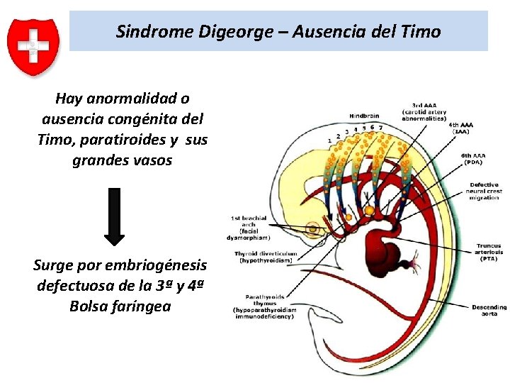 Sindrome Digeorge – Ausencia del Timo Hay anormalidad o ausencia congénita del Timo, paratiroides