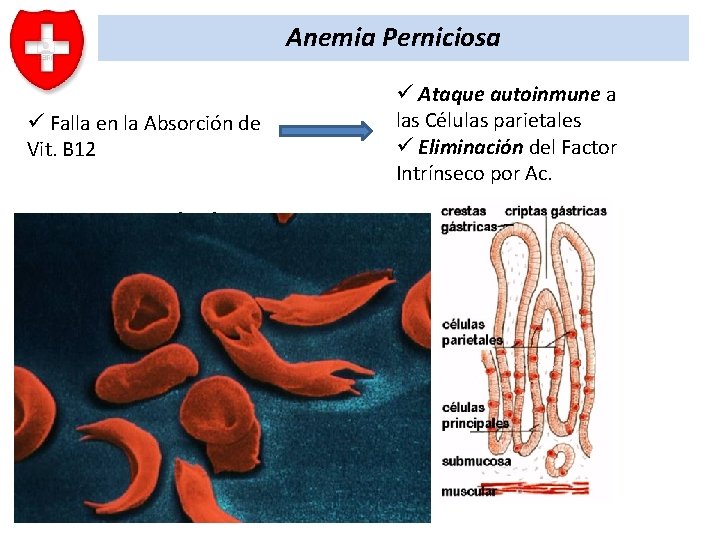 Anemia Perniciosa ü Falla en la Absorción de Vit. B 12 Resultado Deterioro en