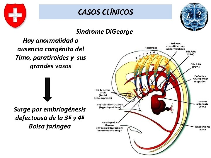 CASOS CLÍNICOS Sindrome Di. George Hay anormalidad o ausencia congénita del Timo, paratiroides y