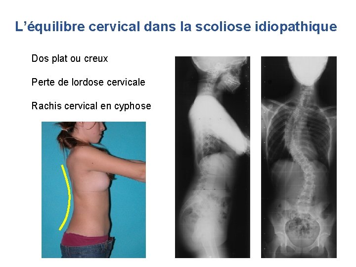 L’équilibre cervical dans la scoliose idiopathique Dos plat ou creux Perte de lordose cervicale L’équilibre cervical dans la scoliose idiopathique Dos plat ou creux Perte de lordose cervicale