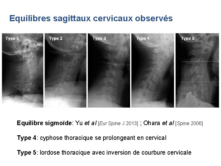 Equilibres sagittaux cervicaux observés Equilibre sigmoïde: Yu et al [Eur Spine J 2013] ;