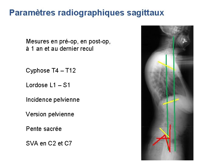 Paramètres radiographiques sagittaux Mesures en pré-op, en post-op, à 1 an et au dernier Paramètres radiographiques sagittaux Mesures en pré-op, en post-op, à 1 an et au dernier