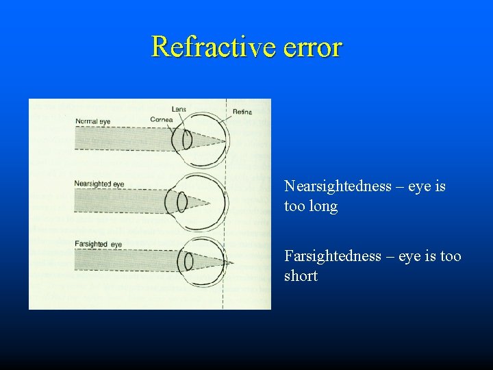 Refractive error Nearsightedness – eye is too long Farsightedness – eye is too short