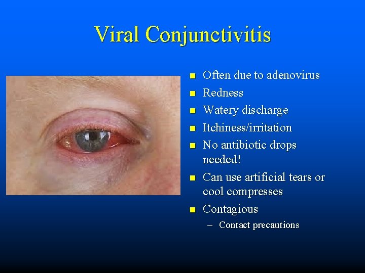 Viral Conjunctivitis n n n n Often due to adenovirus Redness Watery discharge Itchiness/irritation