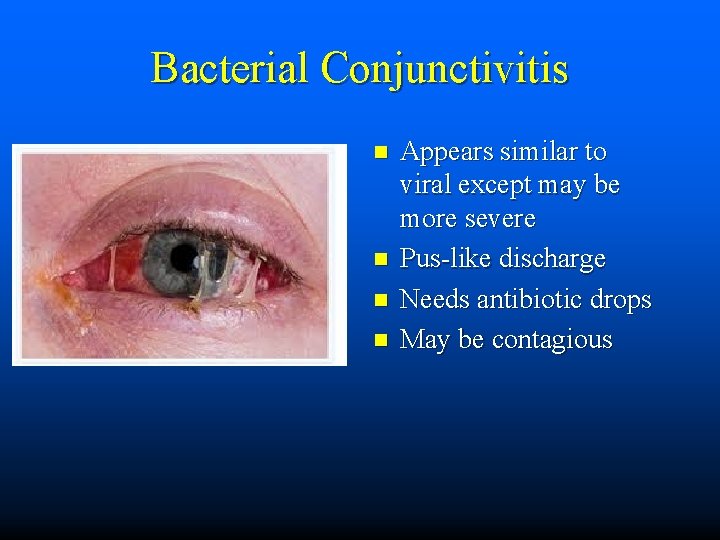 Bacterial Conjunctivitis n n Appears similar to viral except may be more severe Pus-like