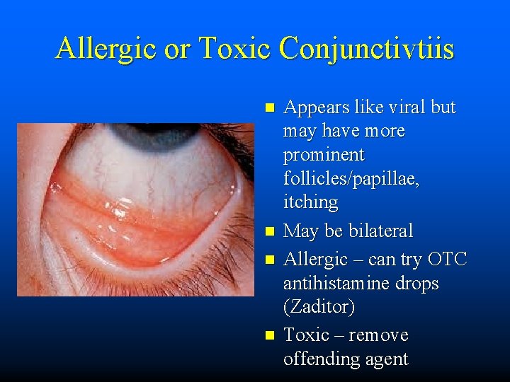 Allergic or Toxic Conjunctivtiis n n Appears like viral but may have more prominent