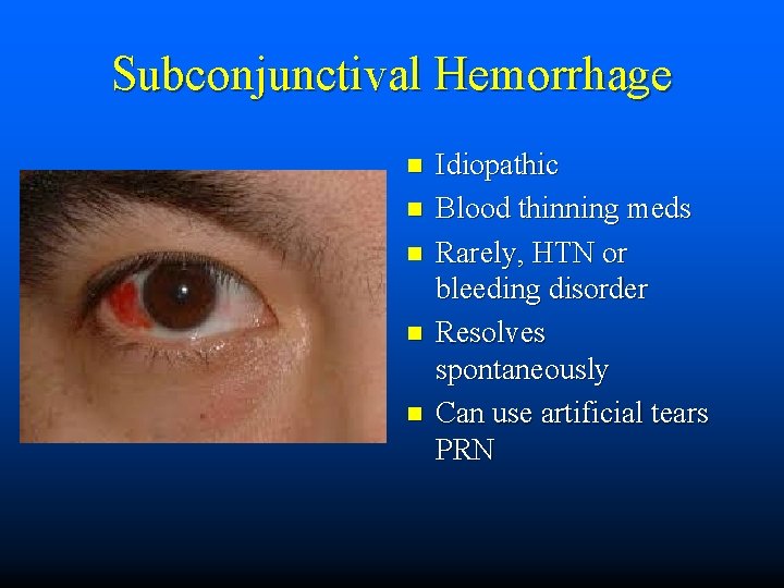 Subconjunctival Hemorrhage n n n Idiopathic Blood thinning meds Rarely, HTN or bleeding disorder