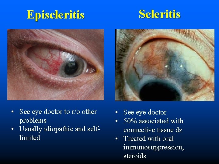 Episcleritis • See eye doctor to r/o other problems • Usually idiopathic and selflimited
