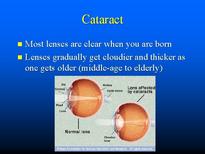 Cataract Most lenses are clear when you are born n Lenses gradually get cloudier