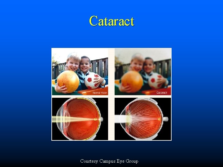 Cataract Courtesy Campus Eye Group 