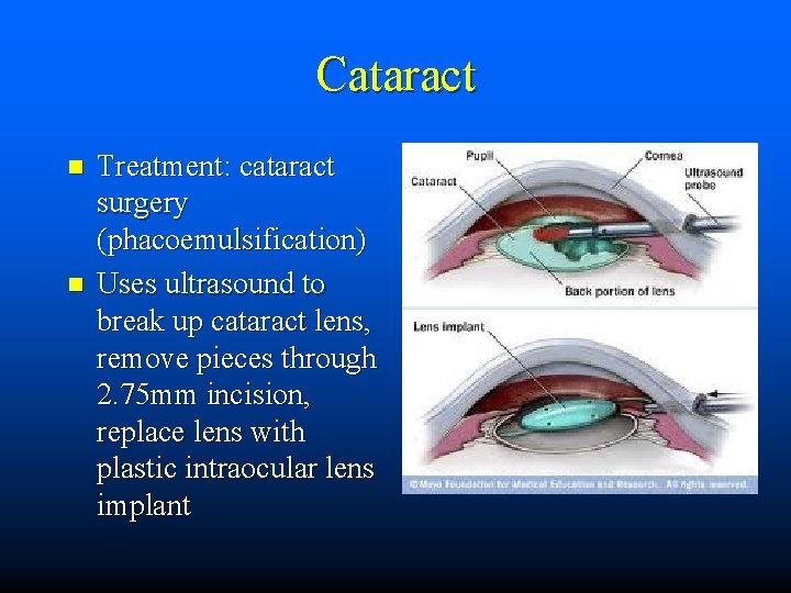 Cataract n n Treatment: cataract surgery (phacoemulsification) Uses ultrasound to break up cataract lens,
