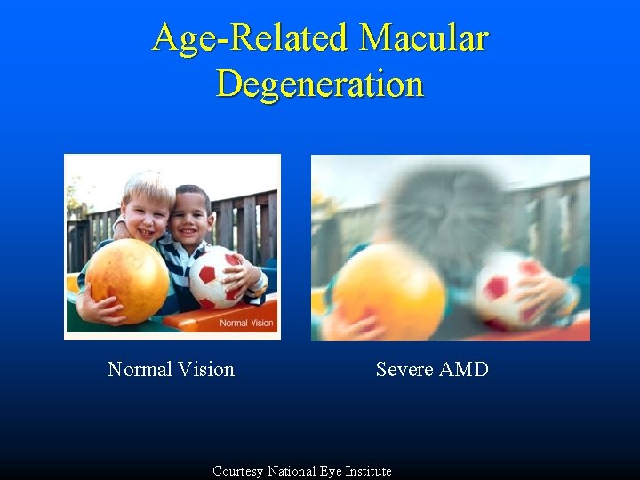 Age-Related Macular Degeneration Normal Vision Severe AMD Courtesy National Eye Institute 