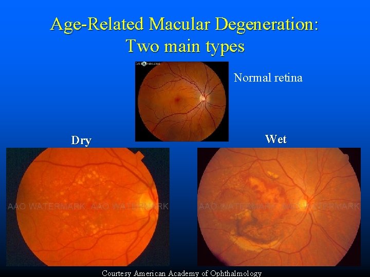 Age-Related Macular Degeneration: Two main types Normal retina Wet Dry Courtesy American Academy of