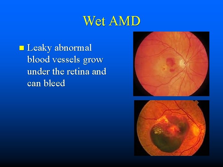 Wet AMD n Leaky abnormal blood vessels grow under the retina and can bleed