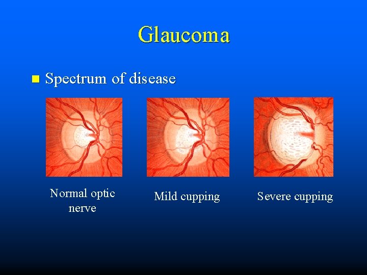 Glaucoma n Spectrum of disease Normal optic nerve Mild cupping Severe cupping 