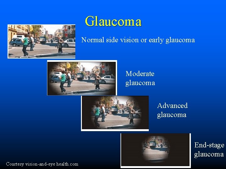 Glaucoma Normal side vision or early glaucoma Moderate glaucoma Advanced glaucoma End-stage glaucoma Courtesy