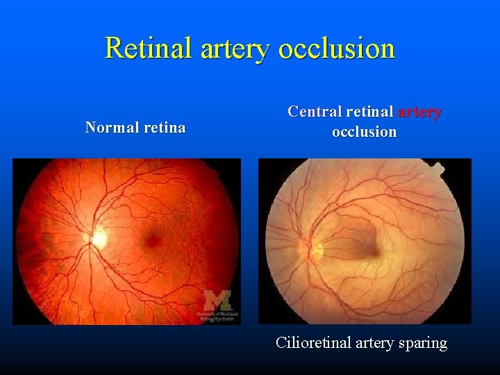 Retinal artery occlusion Normal retina Central retinal artery occlusion Cilioretinal artery sparing 