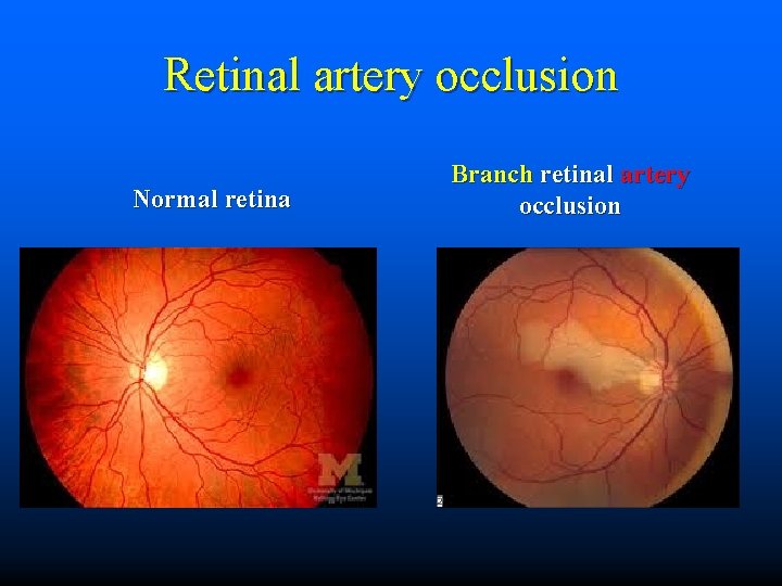 Retinal artery occlusion Normal retina Branch retinal artery occlusion 