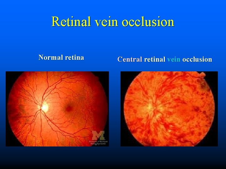 Retinal vein occlusion Normal retina Central retinal vein occlusion 