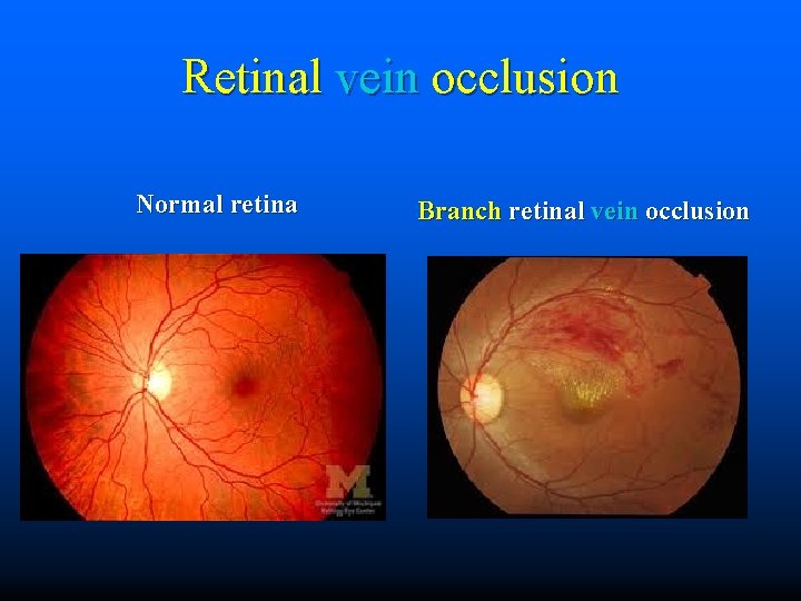 Retinal vein occlusion Normal retina Branch retinal vein occlusion 