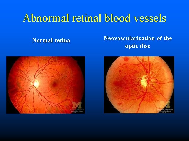 Abnormal retinal blood vessels Normal retina Neovascularization of the optic disc 