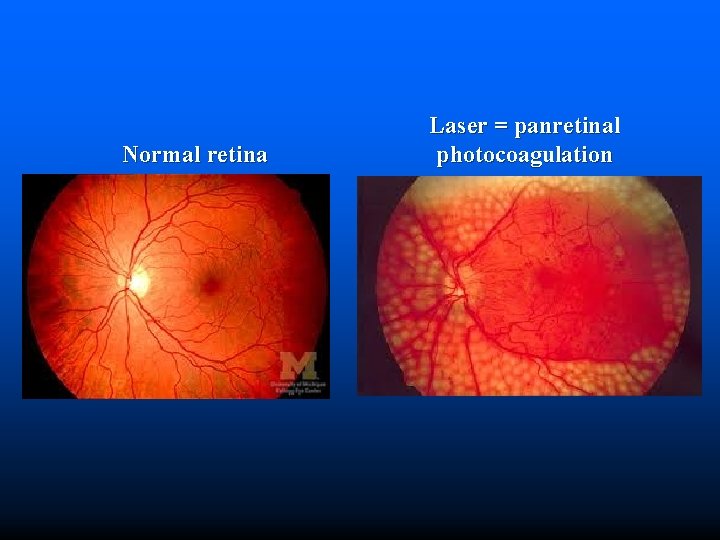 Normal retina Laser = panretinal photocoagulation 
