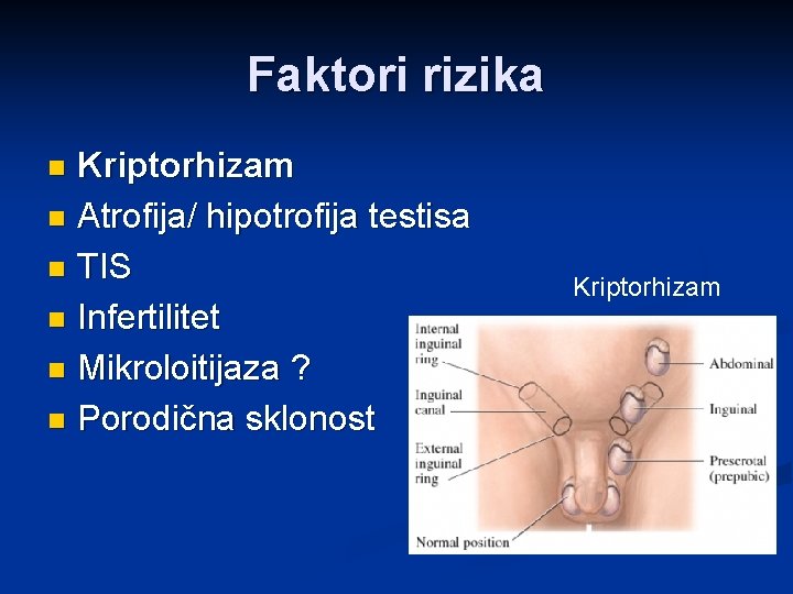 Faktori rizika Kriptorhizam n Atrofija/ hipotrofija testisa n TIS n Infertilitet n Mikroloitijaza ?