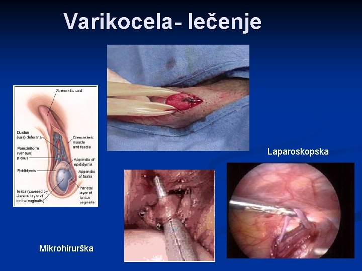 Varikocela- lečenje Laparoskopska Mikrohirurška 