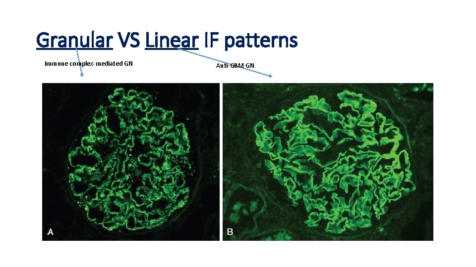 Granular VS Linear IF patterns Immune complex-mediated GN Anti-GBM GN 