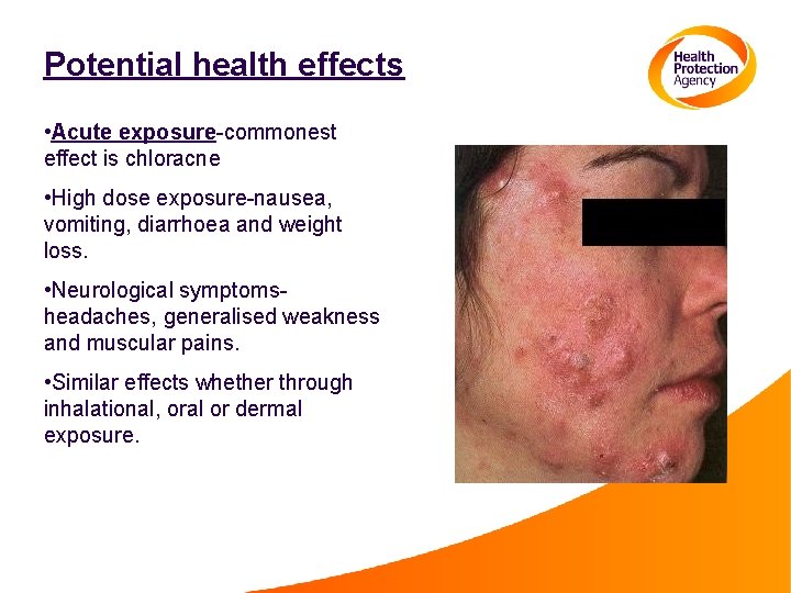 Potential health effects • Acute exposure-commonest effect is chloracne • High dose exposure-nausea, vomiting,