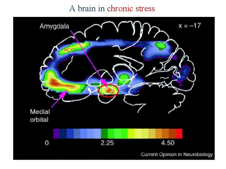 A brain in chronic stress ACC 