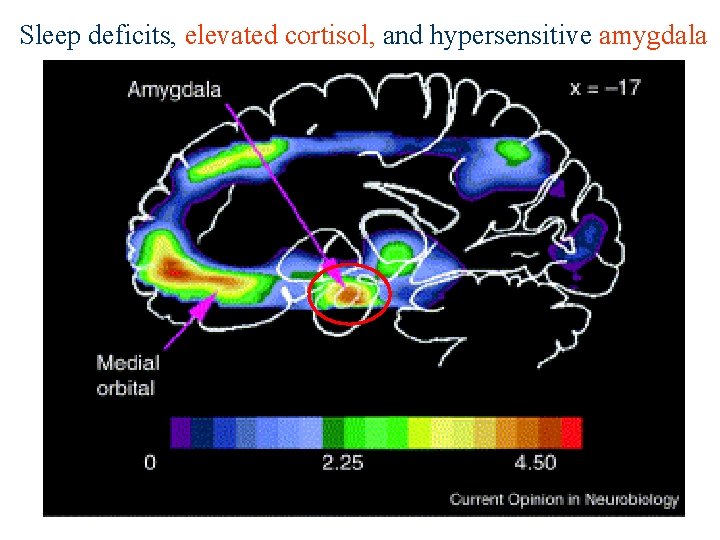 Sleep deficits, elevated cortisol, and hypersensitive amygdala 