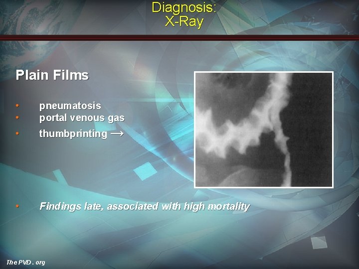 Diagnosis: X-Ray Plain Films • • pneumatosis portal venous gas • thumbprinting → •