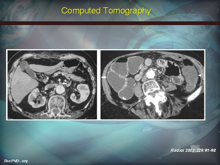 Computed Tomography Radiol 2003; 229: 91 -98 The PVD. org 