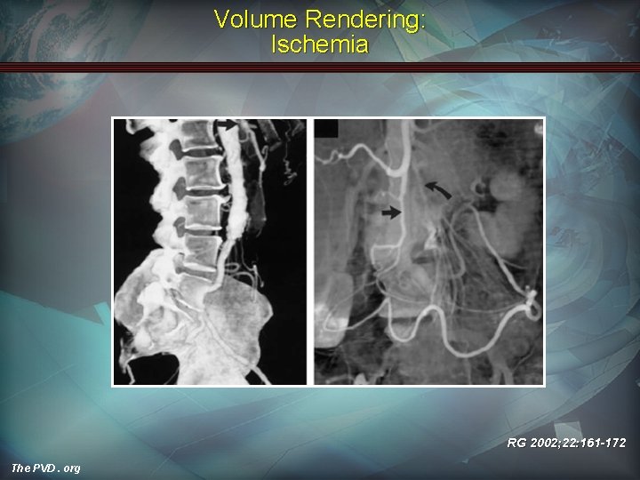 Volume Rendering: Ischemia RG 2002; 22: 161 -172 The PVD. org 