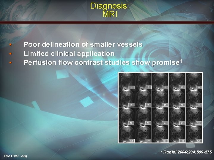 Diagnosis: MRI • • • Poor delineation of smaller vessels Limited clinical application Perfusion