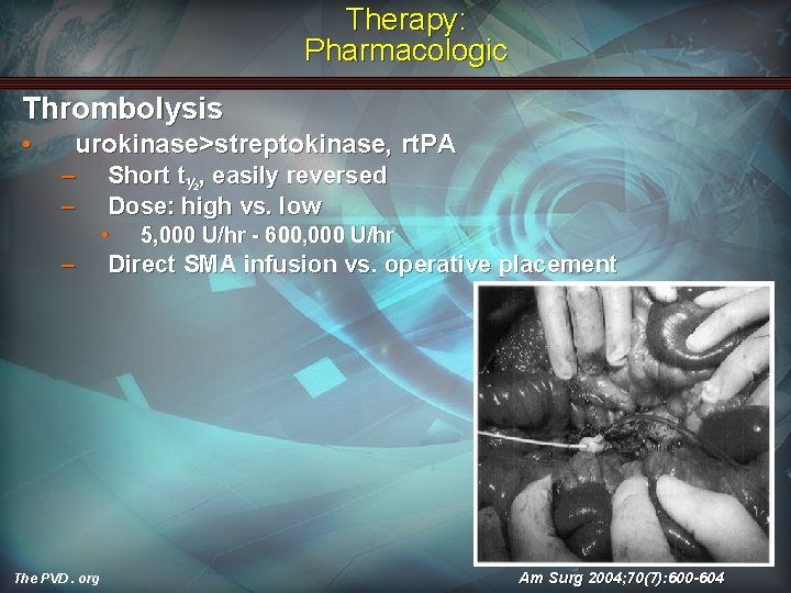 Therapy: Pharmacologic Thrombolysis • urokinase>streptokinase, rt. PA – – Short t½, easily reversed Dose: