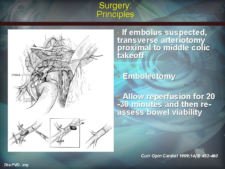 Surgery: Principles If embolus suspected, transverse arteriotomy proximal to middle colic takeoff • •