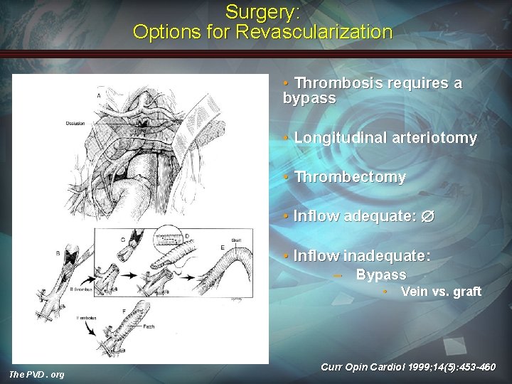Surgery: Options for Revascularization • Thrombosis requires a bypass • Longitudinal arteriotomy • Thrombectomy